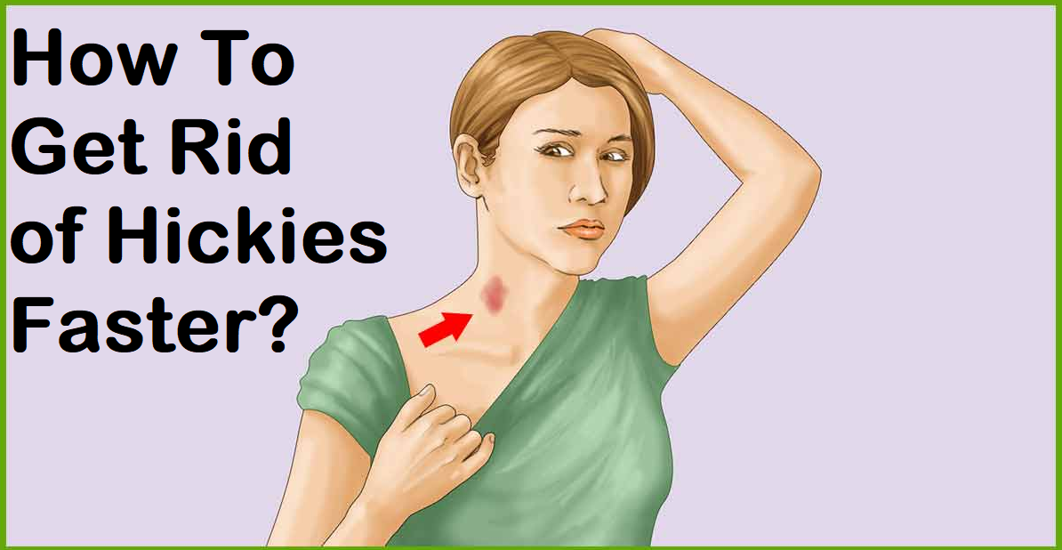 How To Get Rid of Hickies