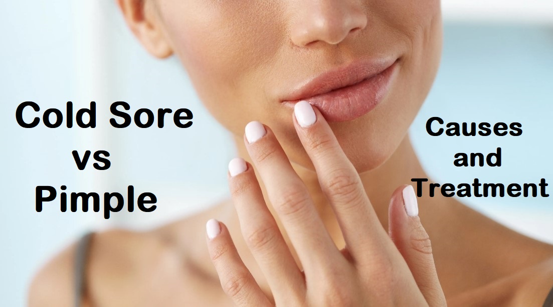 Cold Sore vs Pimple