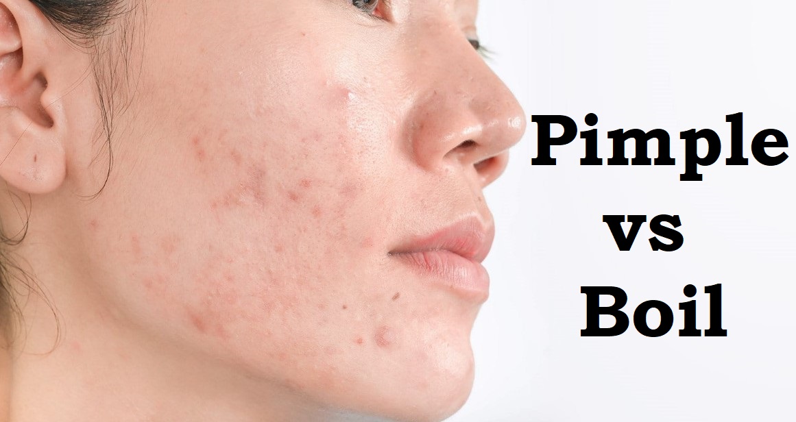 Pimple vs Boil