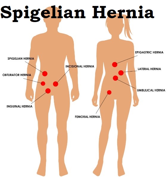 Spigelian Hernia